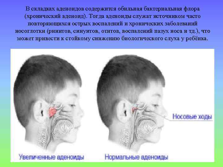 В складках аденоидов содержится обильная бактериальная флора (хронический аденоид). Тогда аденоиды служат источником часто