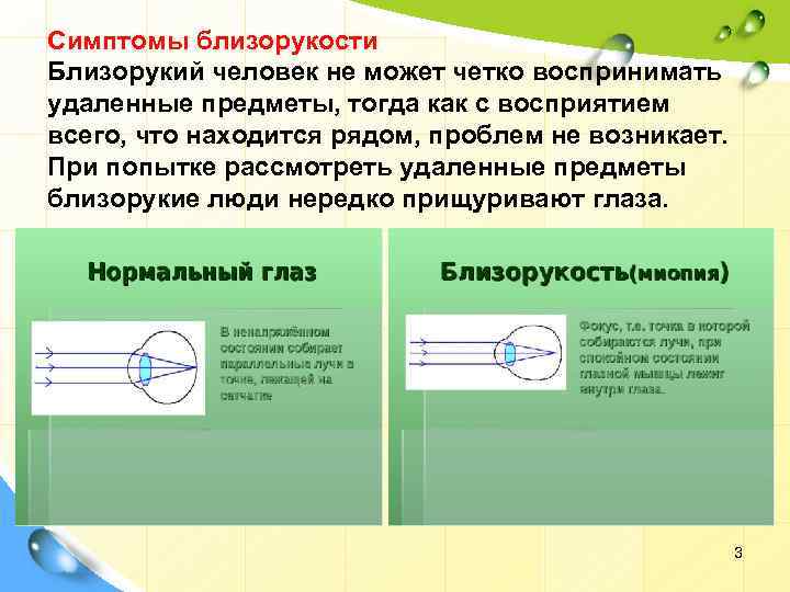 Признаки близорукости