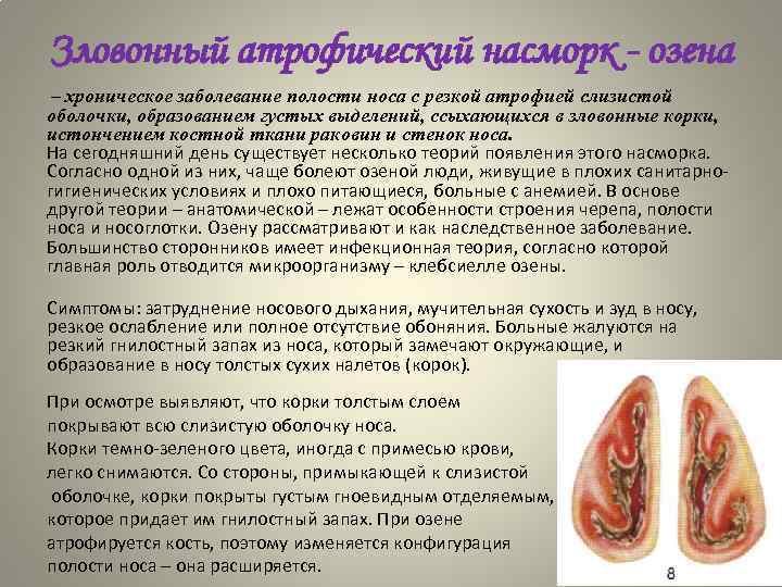 Зловонный атрофический насморк - озена – хроническое заболевание полости носа с резкой атрофией слизистой