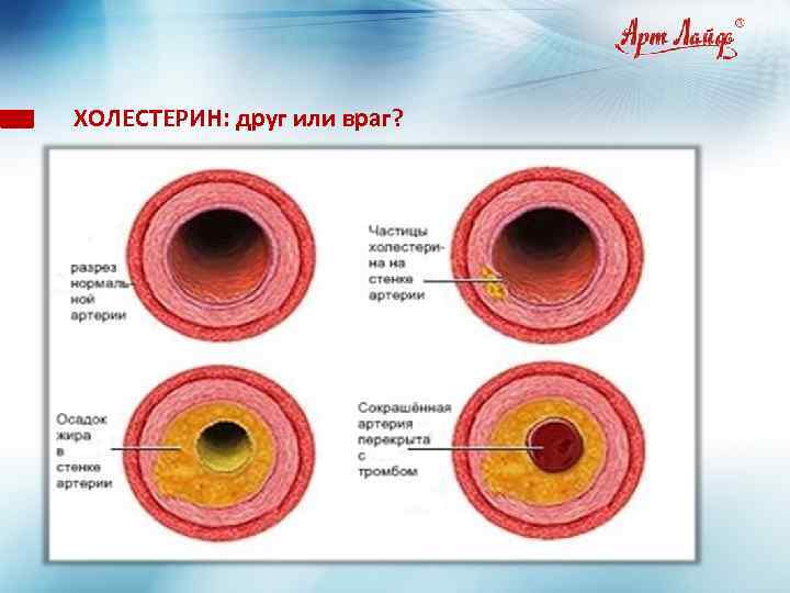 Атеросклероз таблицы