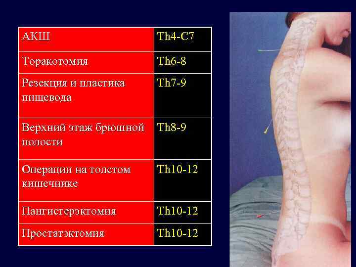 АКШ Торакотомия Th 6 -8 Резекция и пластика пищевода Th 7 -9 Верхний этаж