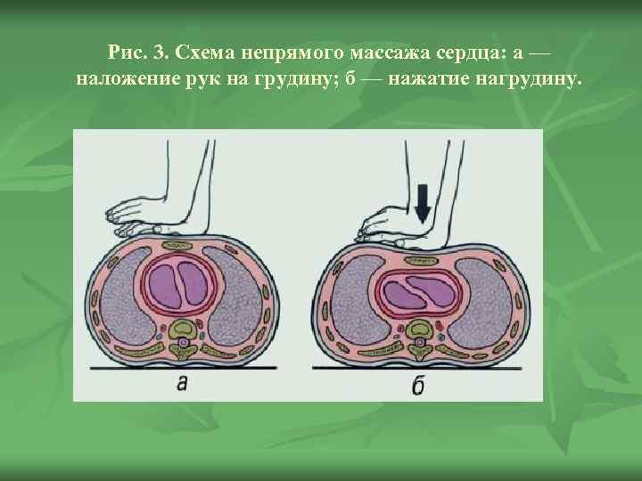 Положение рук при непрямом массаже сердца фото