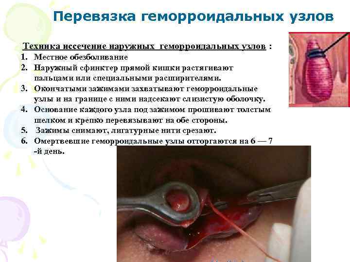 Перевязка геморроидальных узлов Техника иссечение наружных геморроидальных узлов : 1. Местное обезболивание 2. Наружный