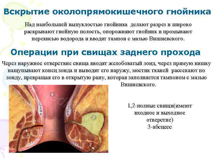 Вскрытие околопрямокишечного гнойника Над наибольшей выпуклостью гнойника делают разрез и широко раскрывают гнойную полость,