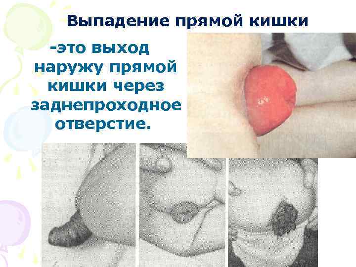 Выпадение прямой кишки -это выход наружу прямой кишки через заднепроходное отверстие. 