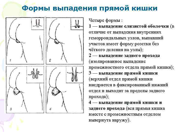Формы выпадения прямой кишки Четыре формы : 1 — выпадение слизистой оболочки (в отличие