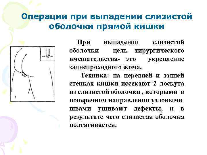 Операции при выпадении слизистой оболочки прямой кишки При выпадении слизистой оболочки цель хирургического вмешательства-