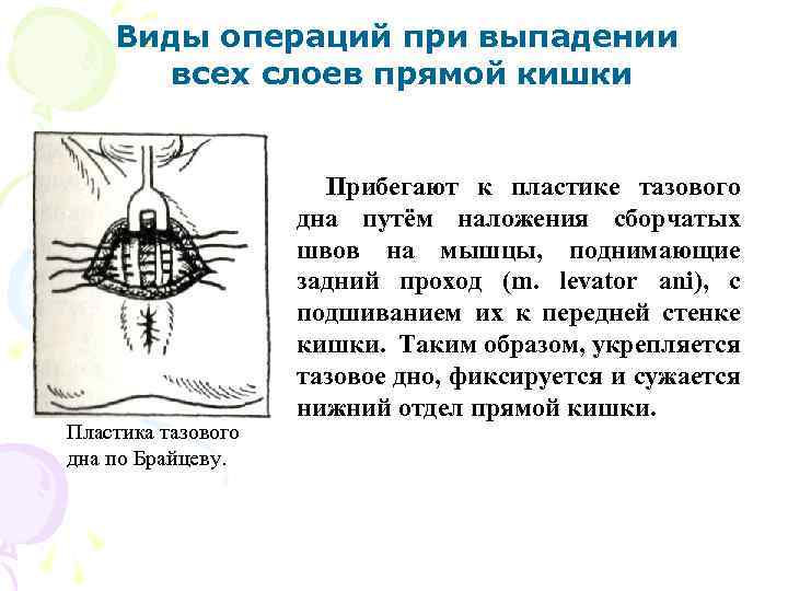Виды операций при выпадении всех слоев прямой кишки Пластика тазового дна по Брайцеву. Прибегают