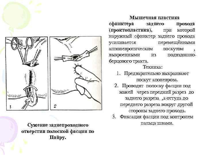 Сужение заднепроходного отверстия полоской фасции по Пайру. Мышечная пластика сфинктера заднего прохода (проктопластика), при