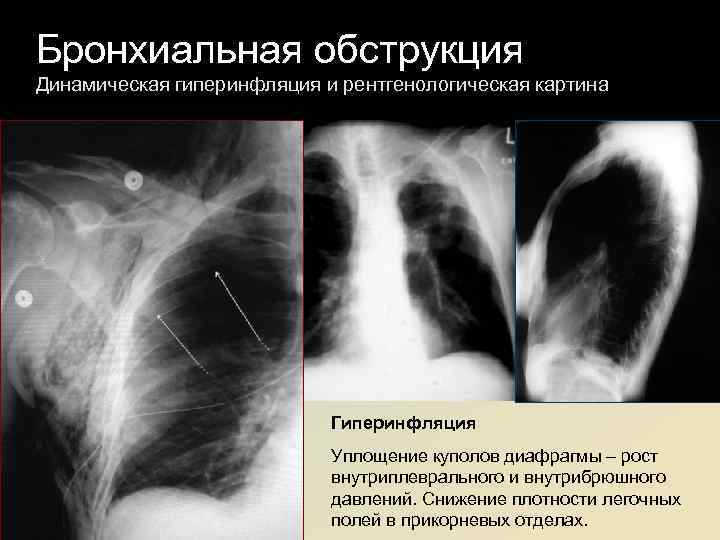 Бронхиальная обструкция. Синдром бронхиальной обструкции рентген. Бронхиальная астма рентген. Бронхиальная обструкция рентген.