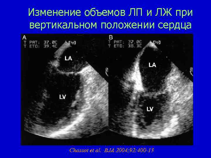 Изменение объемов ЛП и ЛЖ при вертикальном положении сердца Chassot et al. BJA 2004;