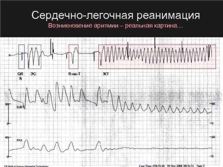 Сердечно легочная реанимация Возникновение аритмии – реальная картина… QR S ЭС R на T