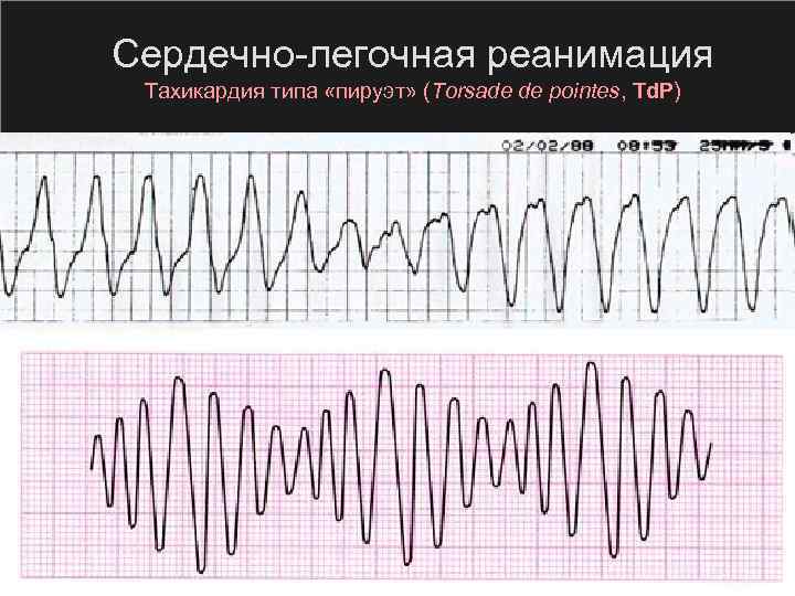 Сердечно легочная реанимация Тахикардия типа «пируэт» (Torsade de pointes, Td. P) 