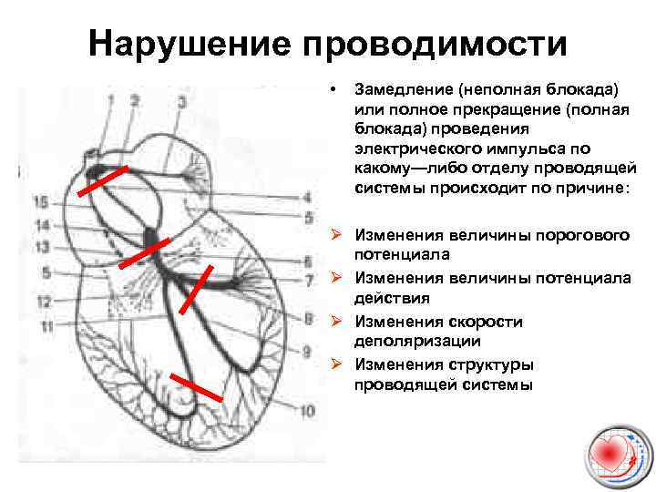 Нарушение проводимости • Замедление (неполная блокада) или полное прекращение (полная блокада) проведения электрического импульса