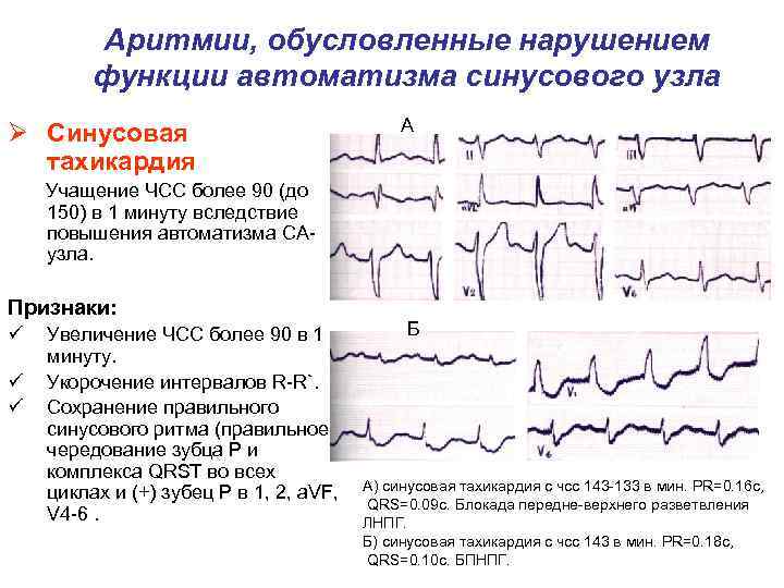 Аритмии, обусловленные нарушением функции автоматизма синусового узла Ø Синусовая тахикардия А Учащение ЧСС более