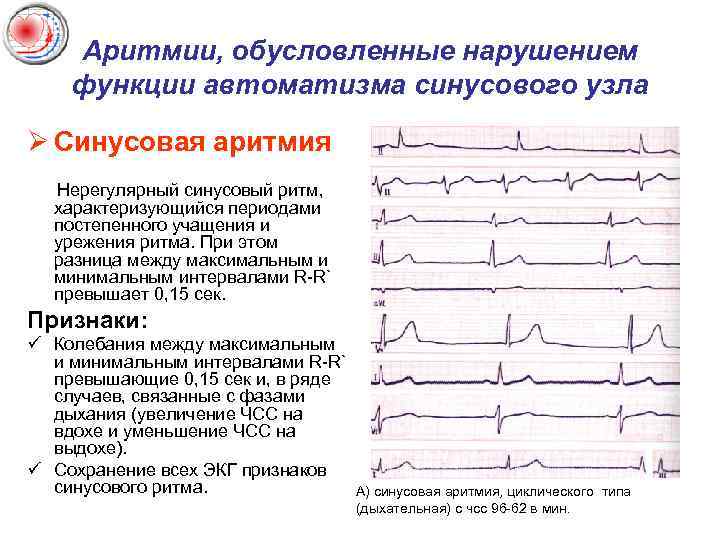 Аритмии, обусловленные нарушением функции автоматизма синусового узла Ø Синусовая аритмия Нерегулярный синусовый ритм, характеризующийся