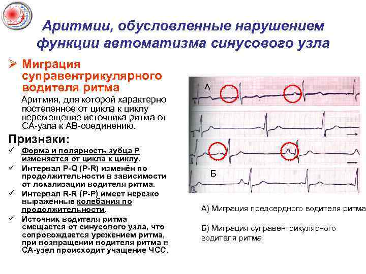 Аритмии, обусловленные нарушением функции автоматизма синусового узла Ø Миграция суправентрикулярного водителя ритма А Аритмия,