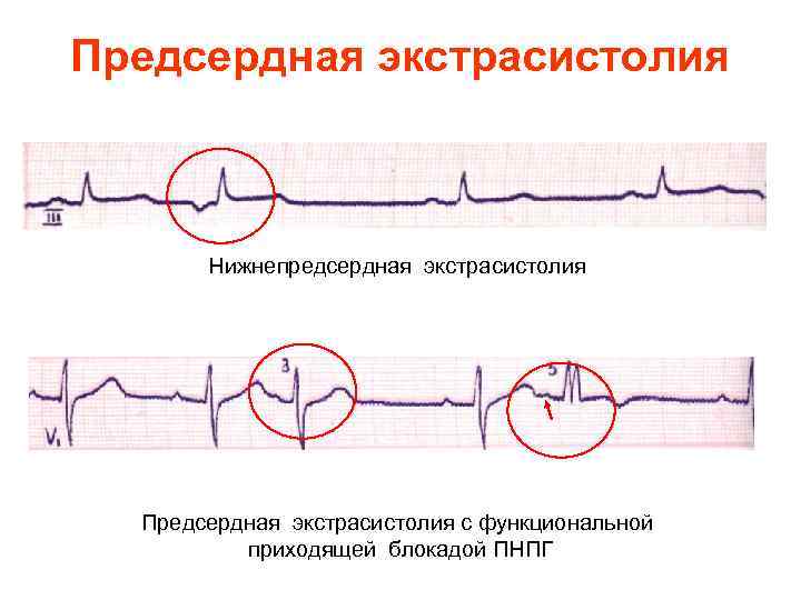 Предсердная экстрасистолия Нижнепредсердная экстрасистолия Предсердная экстрасистолия с функциональной приходящей блокадой ПНПГ 