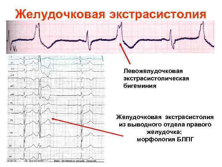 Желудочковая экстрасистолия Левожелудочковая экстрасистолическая бигеминия Желудочковая экстрасистолия из выводного отдела правого желудочка: морфология БЛПГ