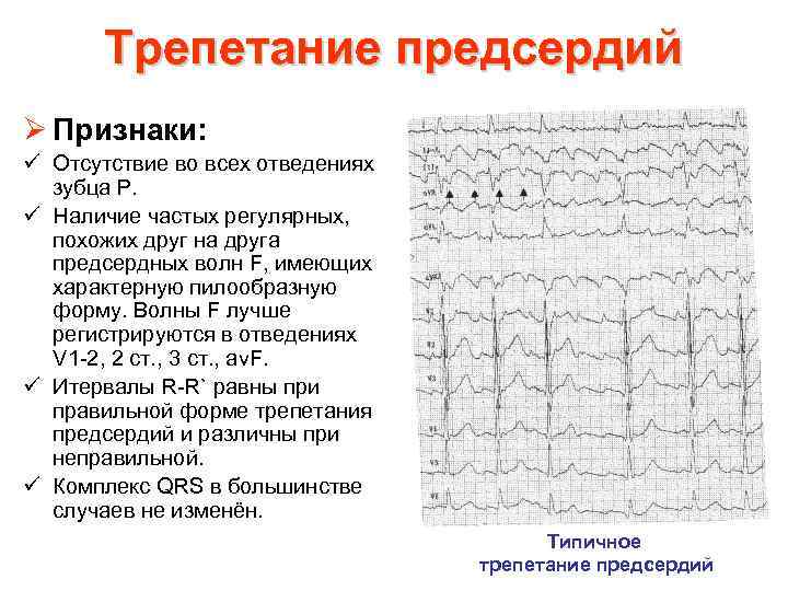 Трепетание предсердий Ø Признаки: ü Отсутствие во всех отведениях зубца Р. ü Наличие частых