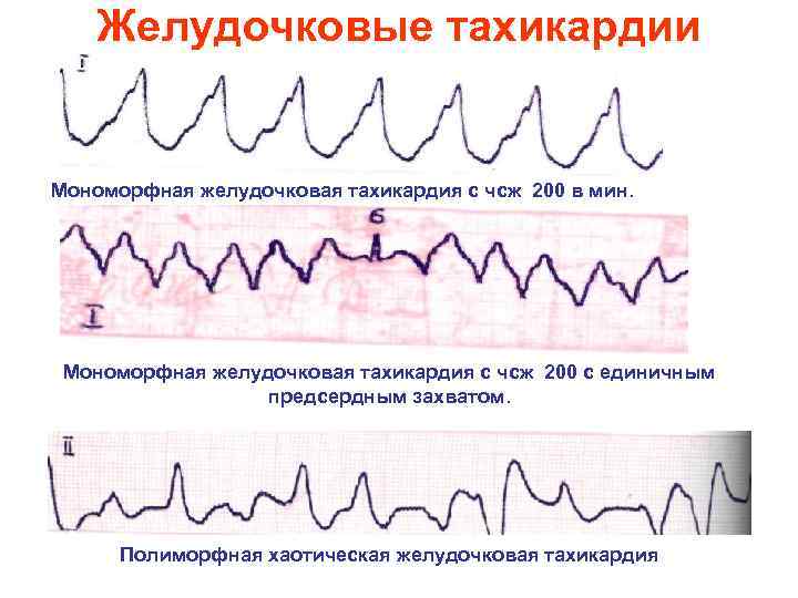 Желудочковые тахикардии Мономорфная желудочковая тахикардия с чсж 200 в мин. Мономорфная желудочковая тахикардия с
