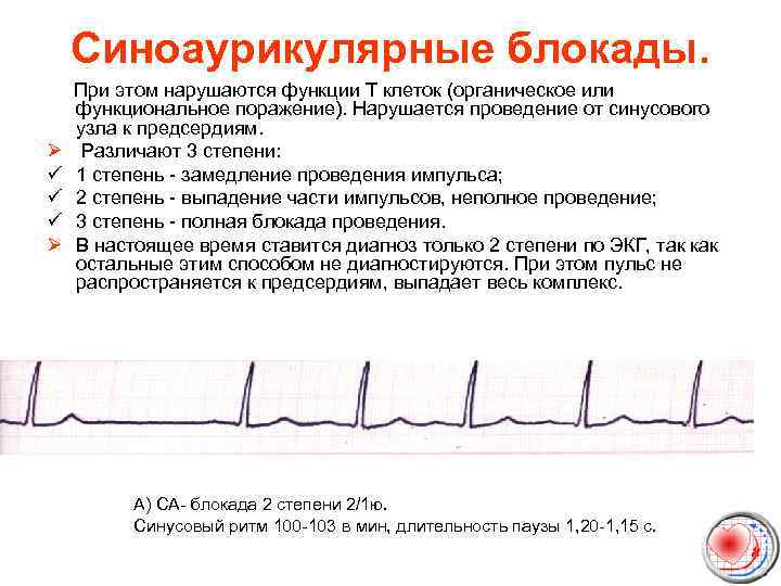 Синоаурикулярные блокады. При этом нарушаются функции Т клеток (органическое или функциональное поражение). Нарушается проведение