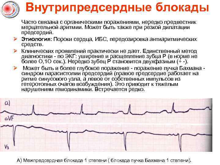 Внутрипредсердные блокады Часто связана с органическими поражениями, нередко предвестник мерцательной аритмии. Может быть также