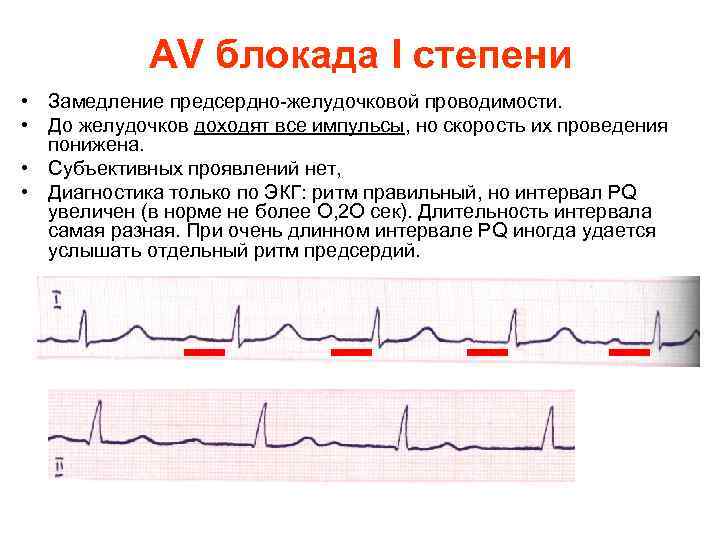 AV блокада I степени • Замедление предсердно желудочковой проводимости. • До желудочков доходят все