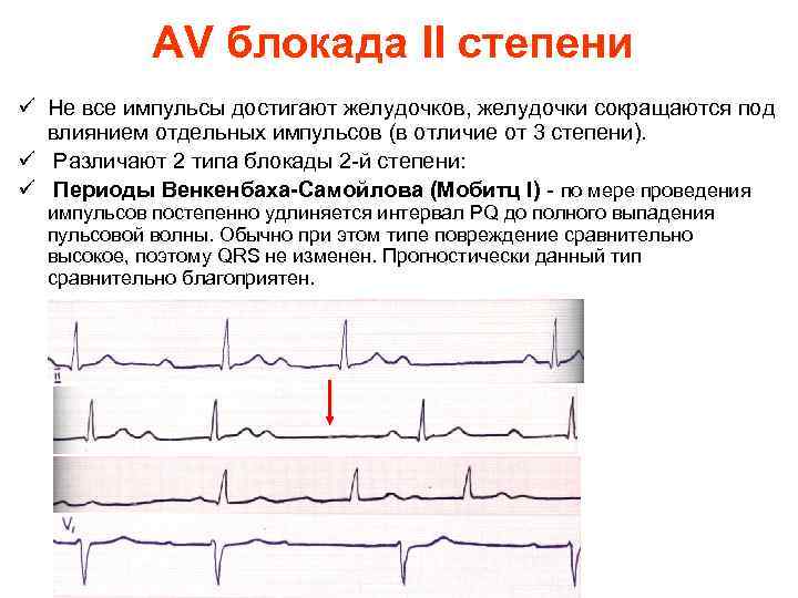 AV блокада II степени ü Не все импульсы достигают желудочков, желудочки сокращаются под влиянием