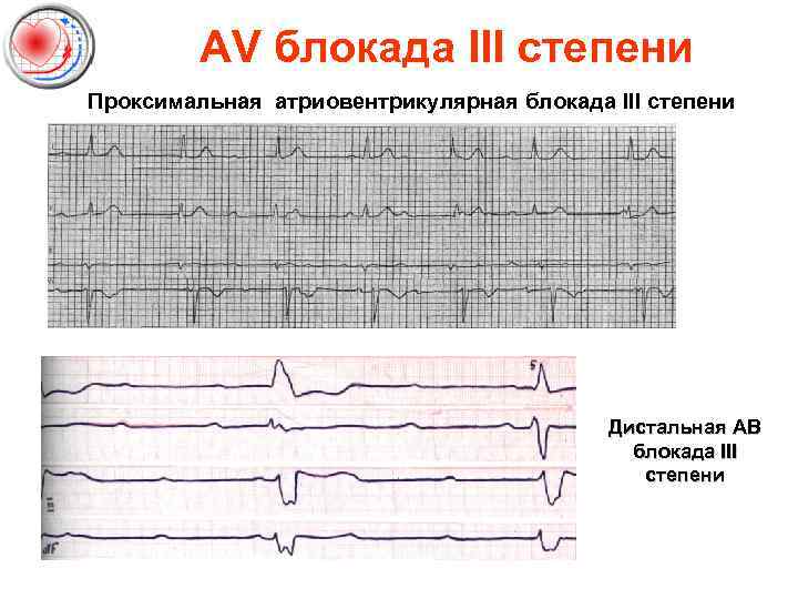 AV блокада III степени Проксимальная атриовентрикулярная блокада III степени Дистальная АВ блокада III степени