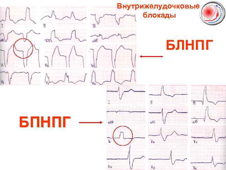 Внутрижелудочковые блокады БЛНПГ БПНПГ 