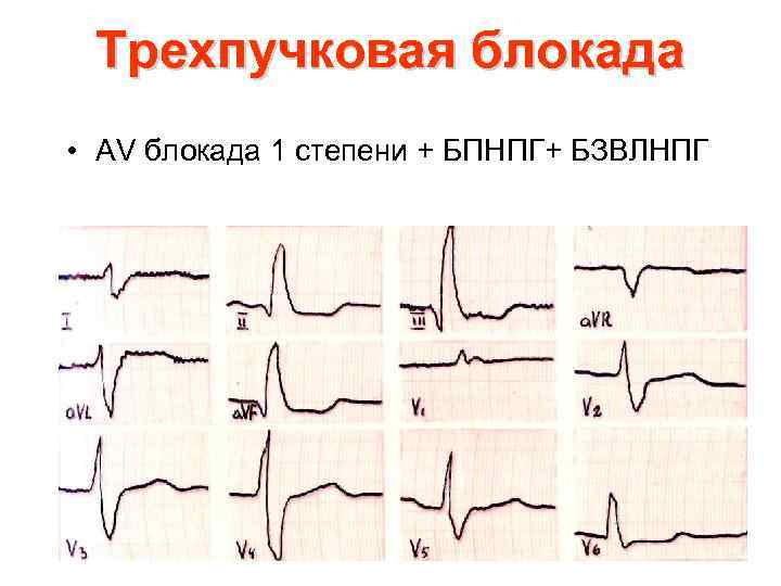 Трехпучковая блокада • АV блокада 1 степени + БПНПГ+ БЗВЛНПГ 
