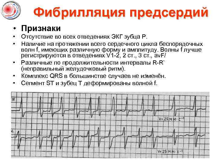  Фибрилляция предсердий • Признаки • Отсутствие во всех отведениях ЭКГ зубца Р. •