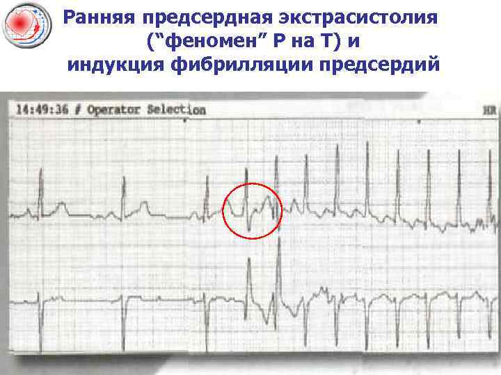 Ранняя предсердная экстрасистолия (“феномен” Р на Т) и индукция фибрилляции предсердий 
