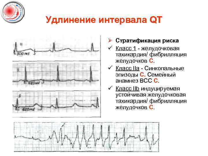 Удлинение интервала QT Ø Стратификация риска ü Класс 1 желудочковая тахикардия/ фибрилляция желудочков С.