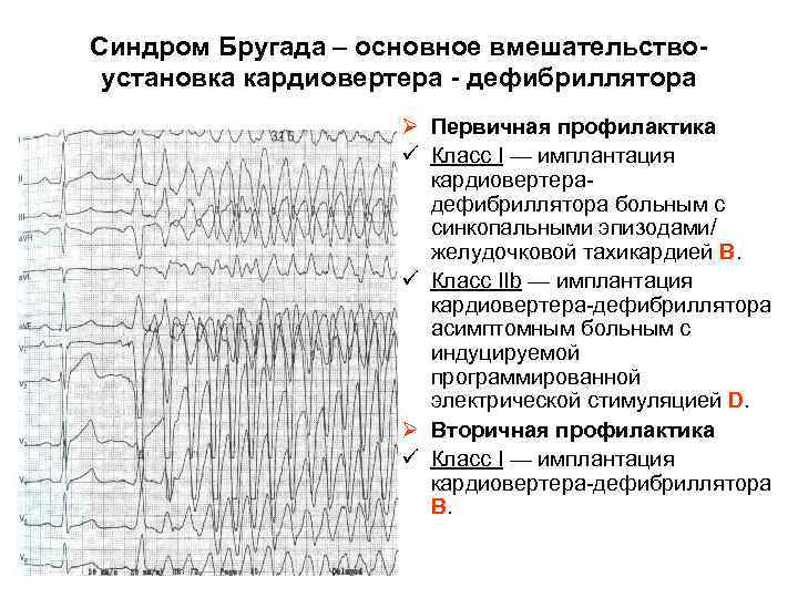 Синдром Бругада – основное вмешательство установка кардиовертера дефибриллятора Ø Первичная профилактика ü Класс I