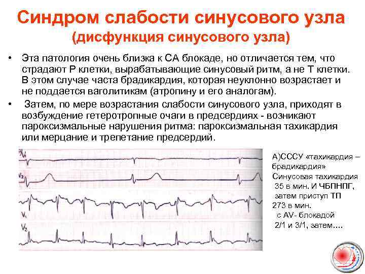 Синдром слабости синусового узла (дисфункция синусового узла) • Эта патология очень близка к СА