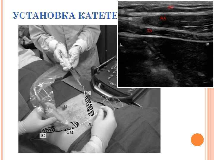 УСТАНОВКА КАТЕТЕРА 