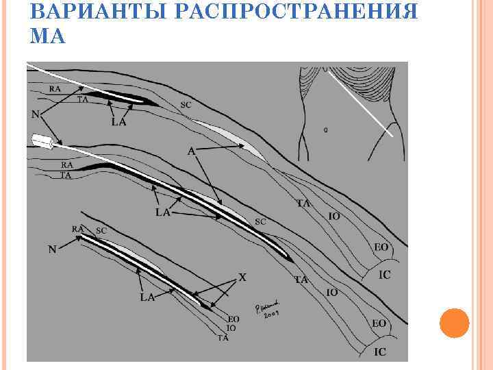 ВАРИАНТЫ РАСПРОСТРАНЕНИЯ МА 