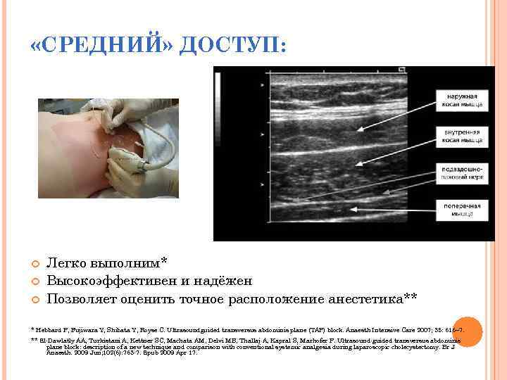  «СРЕДНИЙ» ДОСТУП: Легко выполним* Высокоэффективен и надёжен Позволяет оценить точное расположение анестетика** *