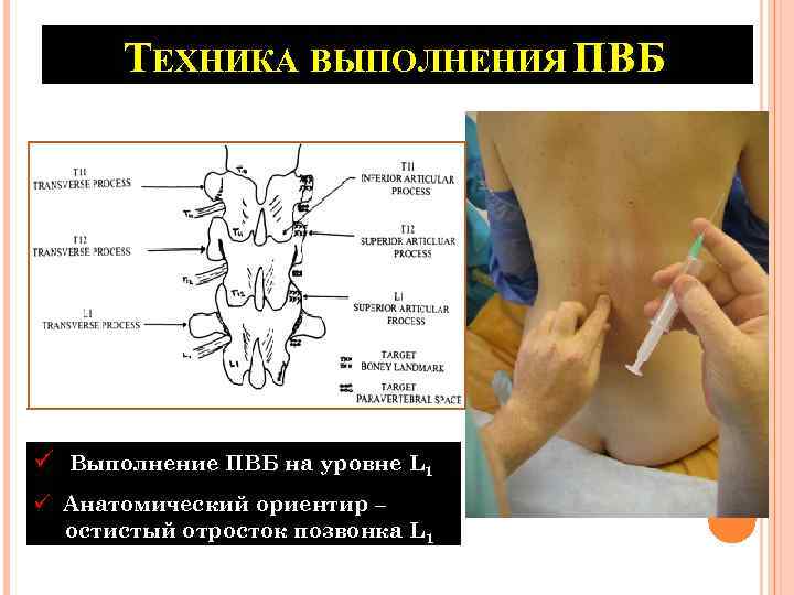 ТЕХНИКА ВЫПОЛНЕНИЯ ПВБ ü Выполнение ПВБ на уровне L 1 ü Анатомический ориентир –