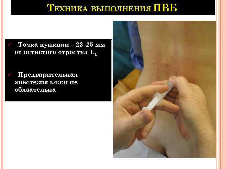 ТЕХНИКА ВЫПОЛНЕНИЯ ПВБ ü Точка пункции – 23– 25 мм от остистого отростка L