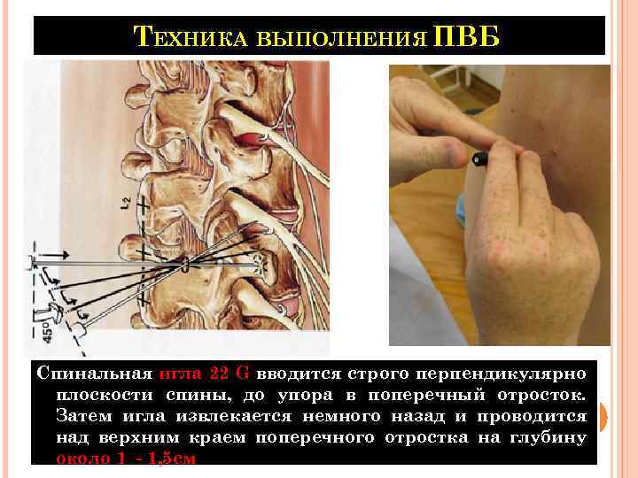 ТЕХНИКА ВЫПОЛНЕНИЯ ПВБ Спинальная игла 22 G вводится строго перпендикулярно плоскости спины, до упора
