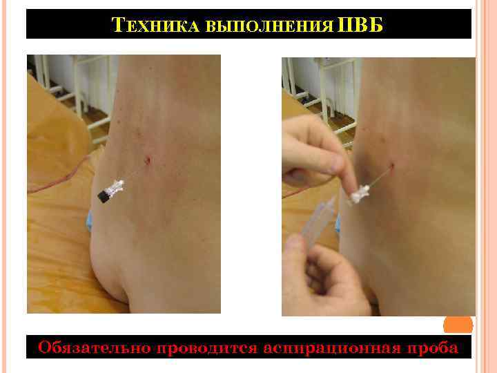 ТЕХНИКА ВЫПОЛНЕНИЯ ПВБ Обязательно проводится аспирационная проба 