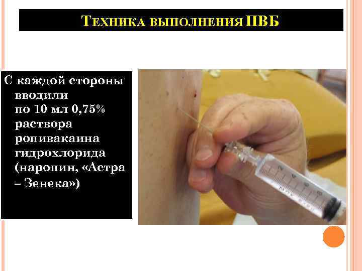 ТЕХНИКА ВЫПОЛНЕНИЯ ПВБ С каждой стороны вводили по 10 мл 0, 75% раствора ропивакаина