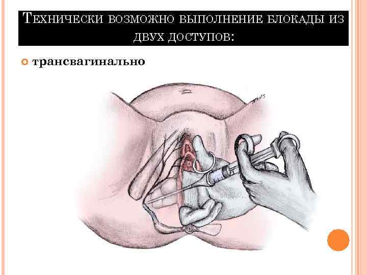 ТЕХНИЧЕСКИ ВОЗМОЖНО ВЫПОЛНЕНИЕ БЛОКАДЫ ИЗ ДВУХ ДОСТУПОВ: трансвагинально 