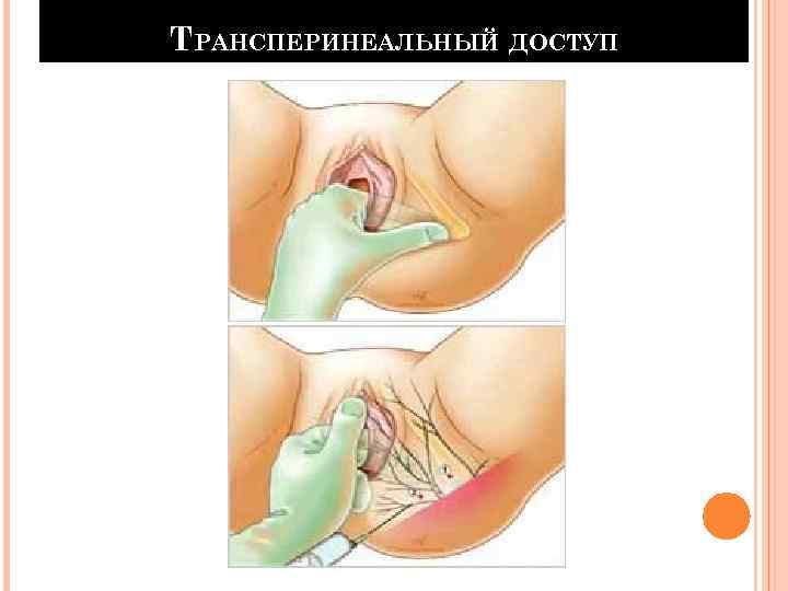 ТРАНСПЕРИНЕАЛЬНЫЙ ДОСТУП 