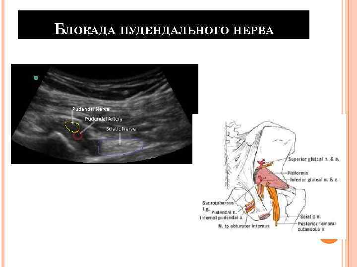 БЛОКАДА ПУДЕНДАЛЬНОГО НЕРВА 