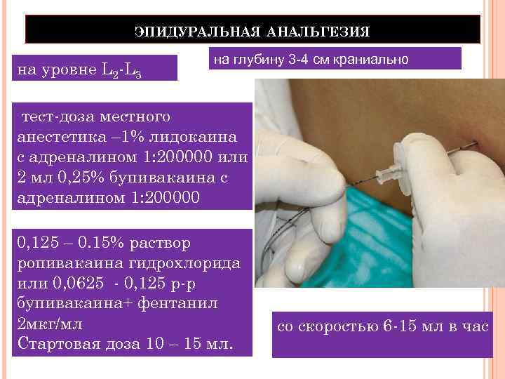 ЭПИДУРАЛЬНАЯ АНАЛЬГЕЗИЯ на уровне L 2 -L 3 на глубину 3 -4 см краниально
