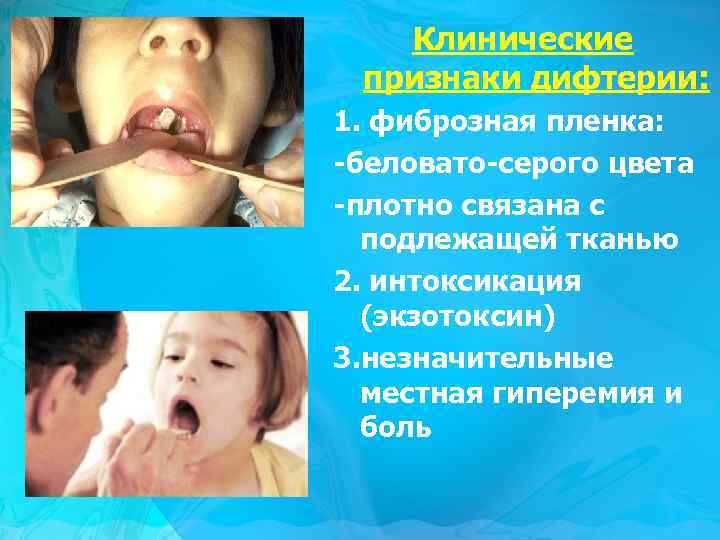Клинические признаки дифтерии: 1. фиброзная пленка: -беловато-серого цвета -плотно связана с подлежащей тканью 2.